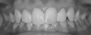 transformation-1-before, Birmingham AL, Jasper AL, types of treatment